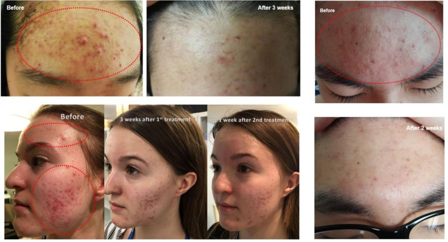 2 in 1 Newest Plasma Shower for Acne Multifunction Facial Lifting Acne Removal