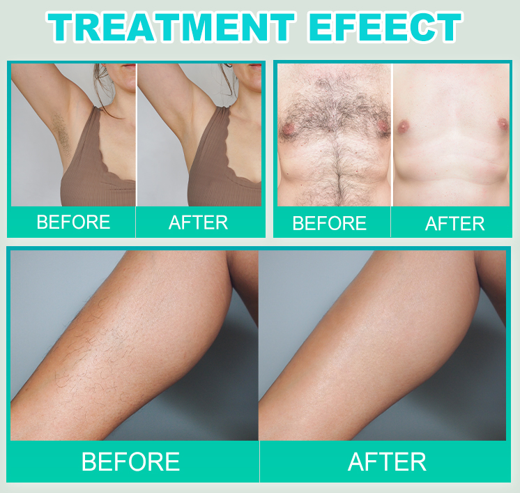 Wholesale Price Needle-Epilation Painless Hair Removal Electrolysis Machine with Needle*10PCS for Self Use