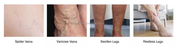 Vascular Laser Treatment