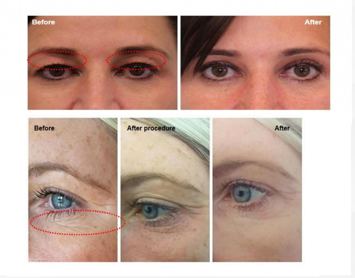 Aesthetic Facial Removal Striae Gravidarum Anti-Wrinkle Lifting Shower 25 Pins Fractional Plasma