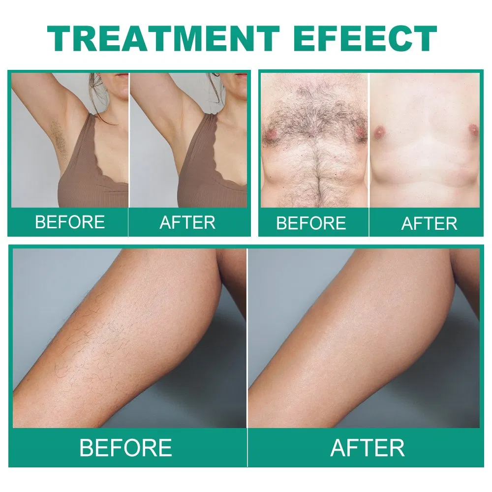 2025 Portable Electro Epilator Device Painless Electrolysis Machine Needle Hair Removal Machine