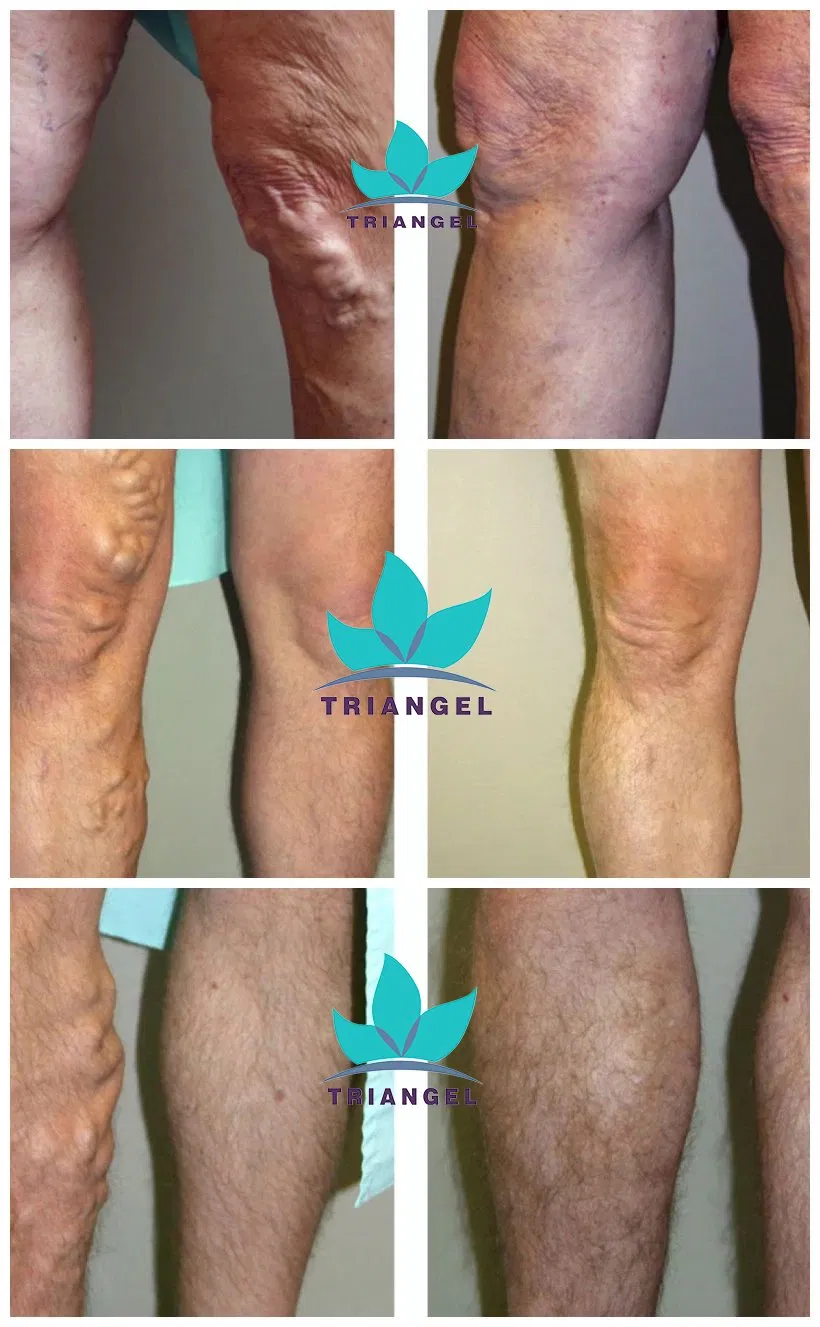 980nm Evlt Varicose Veins Treatment Removal 1470 Diode Endovenous Laser