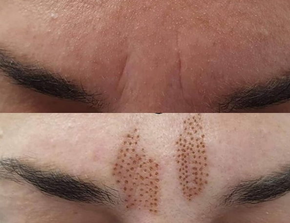 Skin Whitening Plasma Ozone Plasma Pen for Eye Lift Stretch Marks Removal Machine