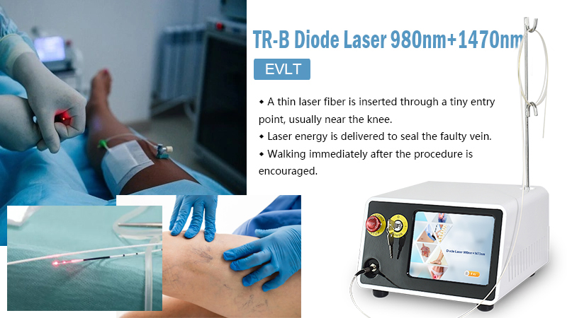 Medical Equipment Surgical Evlt Laser Endovascular 980nm 1470nm Radial Fiber