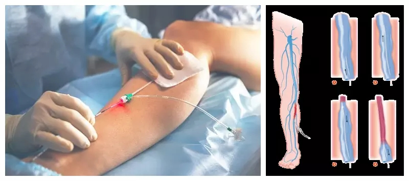 980nm Evlt Varicose Veins Treatment Removal 1470 Diode Endovenous Laser
