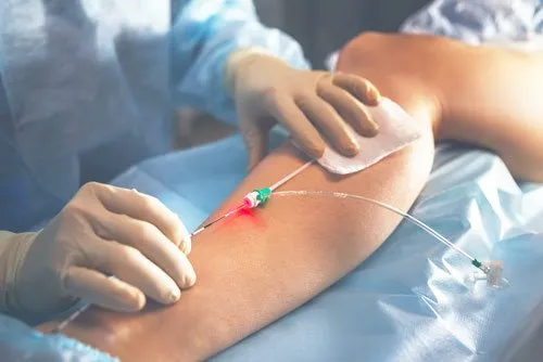Endovenous Procedure