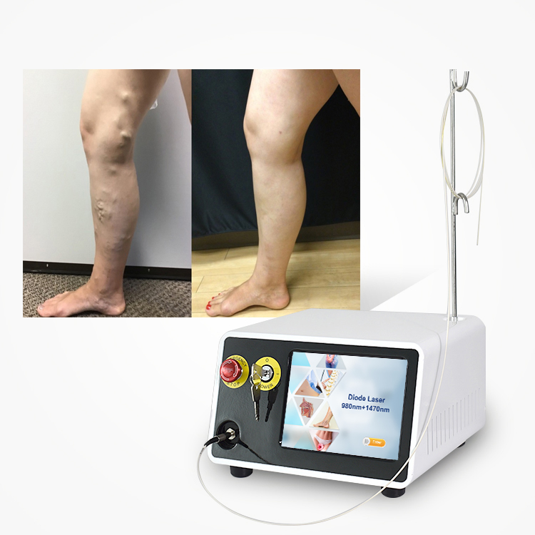 980nm 1470nm Evlt Leg Removal Varicose Veins Treatment Machine Laser De Diodo