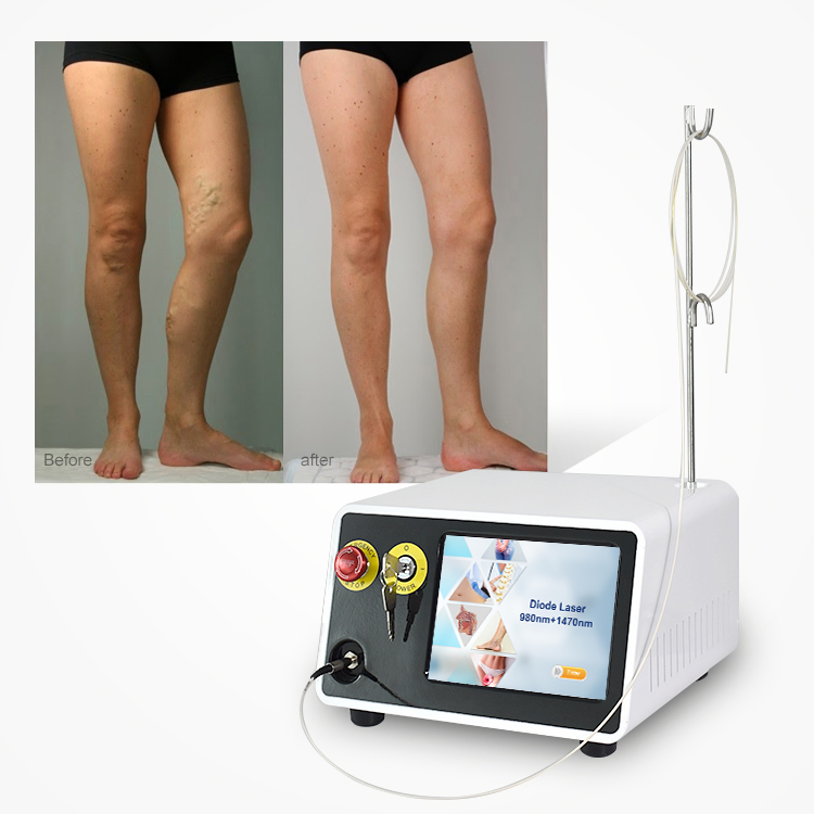 980nm 1470nm Evlt Leg Removal Varicose Veins Treatment Machine Laser De Diodo