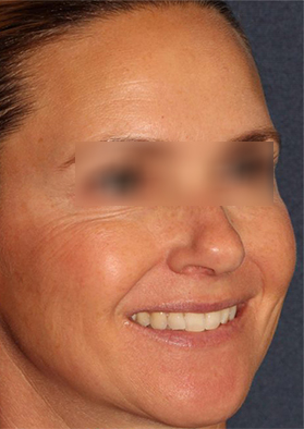 After microneedling treatment