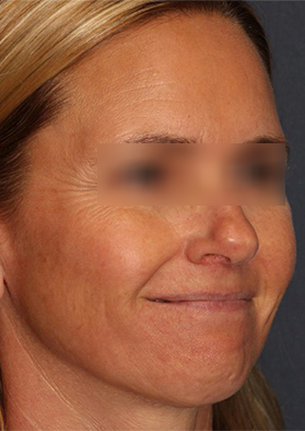 Before microneedling treatment