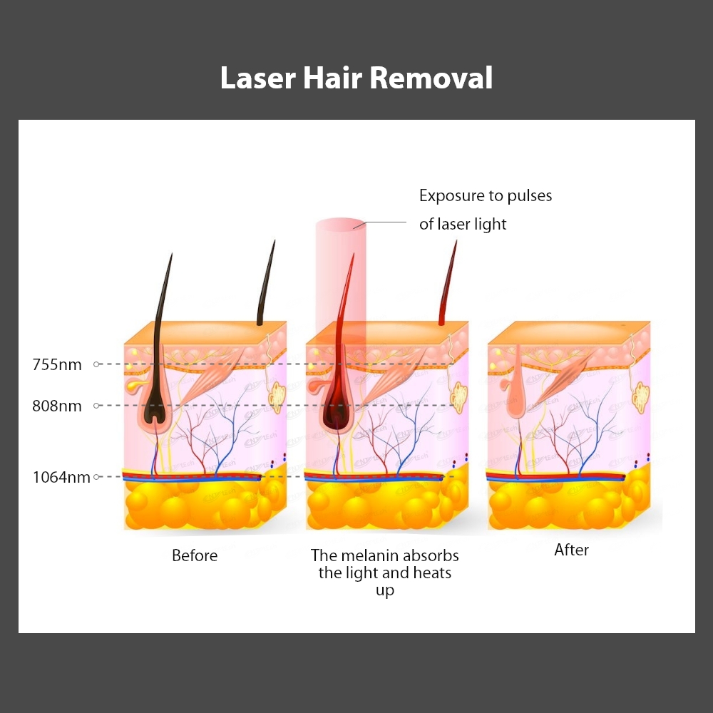 Android Sysytem Beauty Machine Portable Painless Trio Diode Laser Hair Removal for All Color Skin