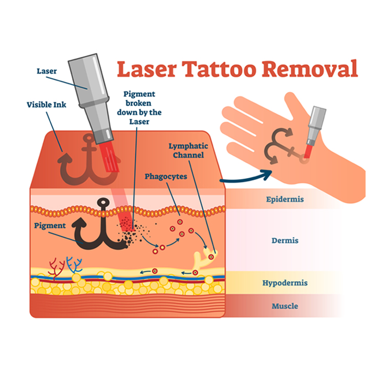 Laser Principle