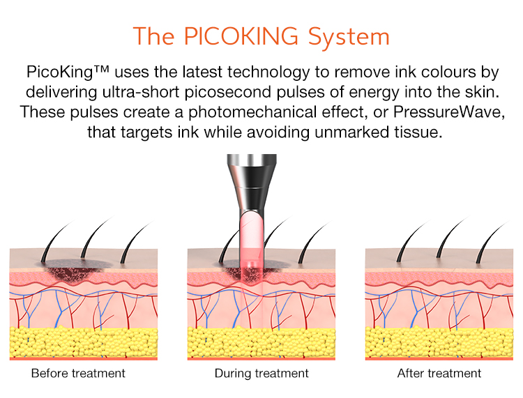 Professional Picosecond Laser 532nm/755nm Tattoo Removal Acne Treatment Skin Rejuvenation Commercial Use Machine