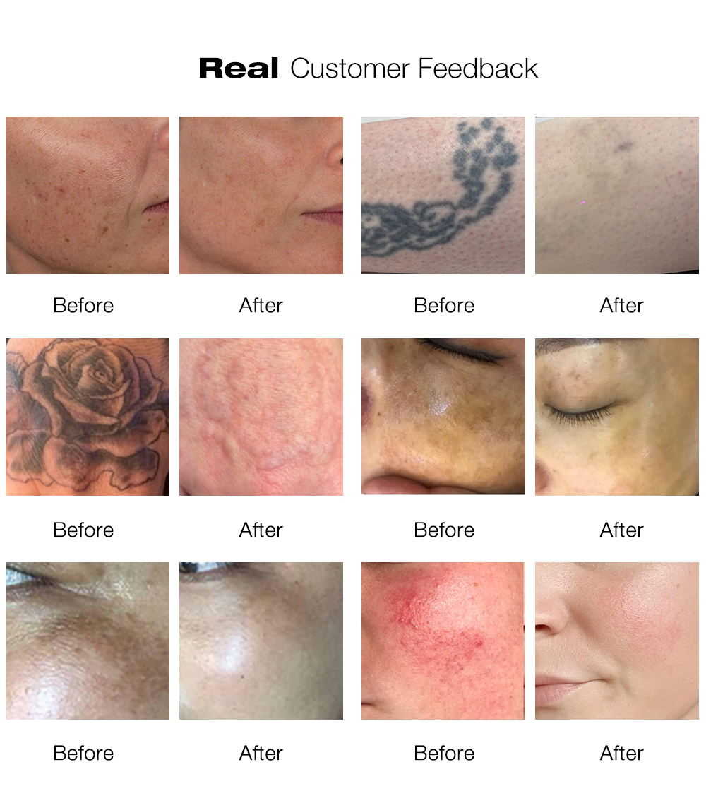 Professional Picosecond Laser 532nm/755nm Tattoo Removal Acne Treatment Skin Rejuvenation Commercial Use Machine