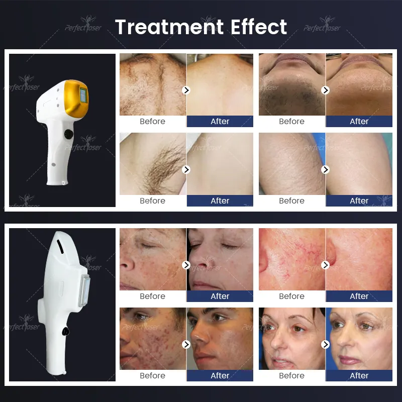IPL Laser Hair Removal Fast Skin Rejuvenation Customizable Device