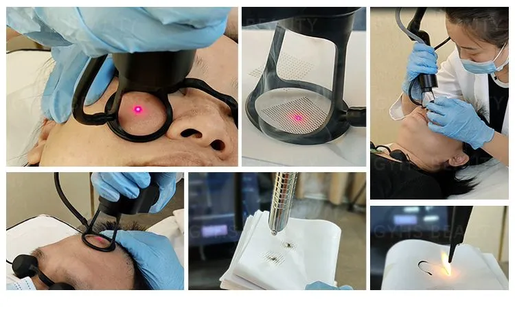 Professional Fractional CO2 Laser Acne Scar Removal Pigmentation Skin Rejuvenation Machine