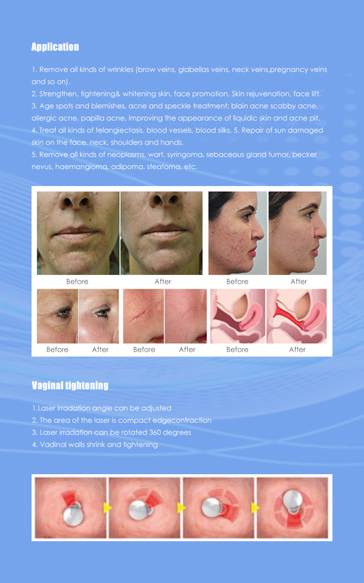 CO2 Fractional Laser Details 2