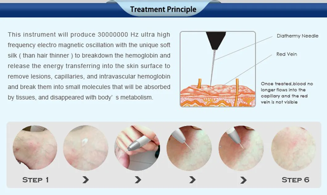Precision Needle Pen