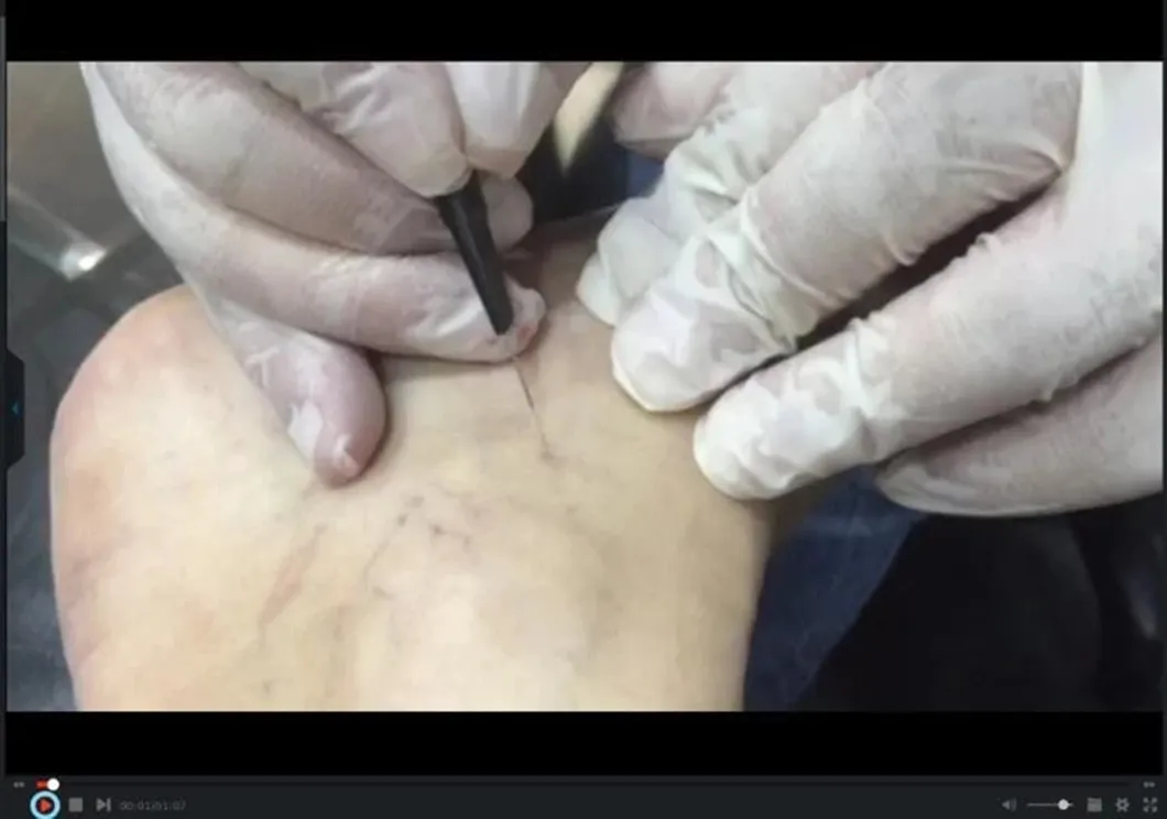 Painless Vein Wave Treatment Screen