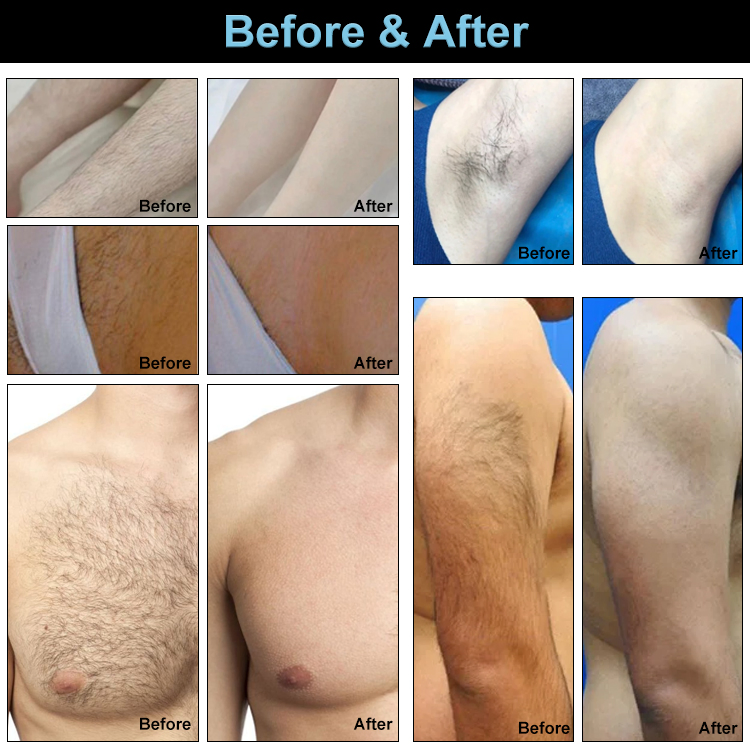 Newest Hair Removal &amp; Tattoo Removal 808nm Diode and Picosecond Laser 2 in 1 Pigmentation Machine