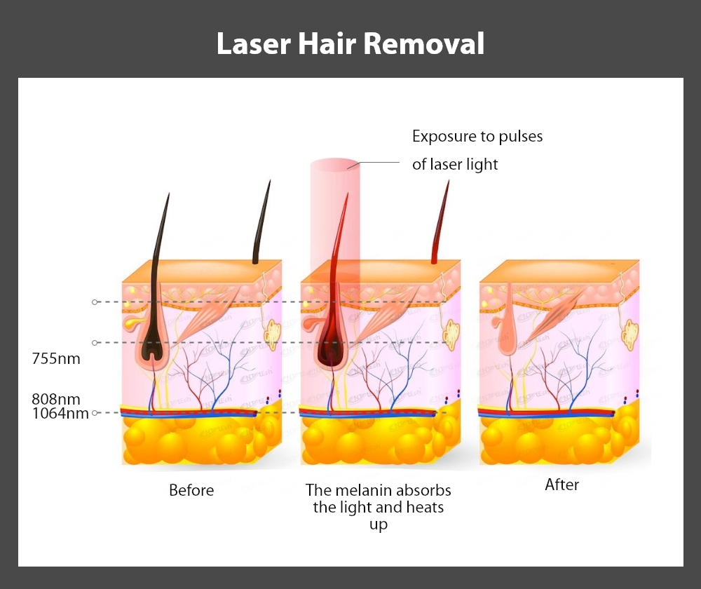 Diode Laser Technology