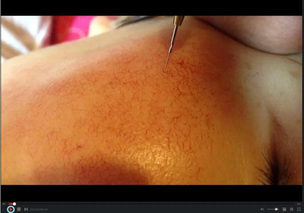 Vascular Removal Device View