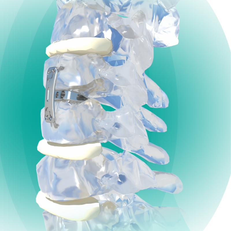 Surgical Medical Titanium Alloy Wedge Curved Anterior Cervical Interbody Fusion Orthopedic Surgery Implant CE Certified Class