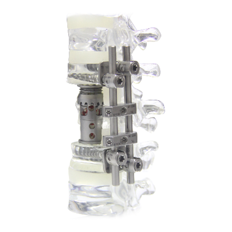 High Quality Titanium Artificial Vertebral Body Implantable Medical Device for Spine Surgery