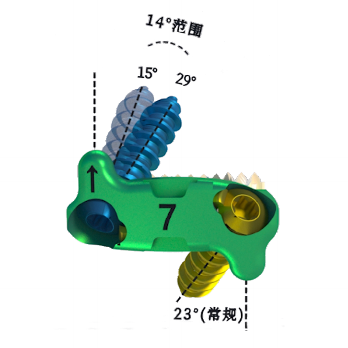 Orthopedic Surgical Implants Titanium Fedex Customized Zero Profile Anterior Cervical Cage Instruments Class III CE Certified