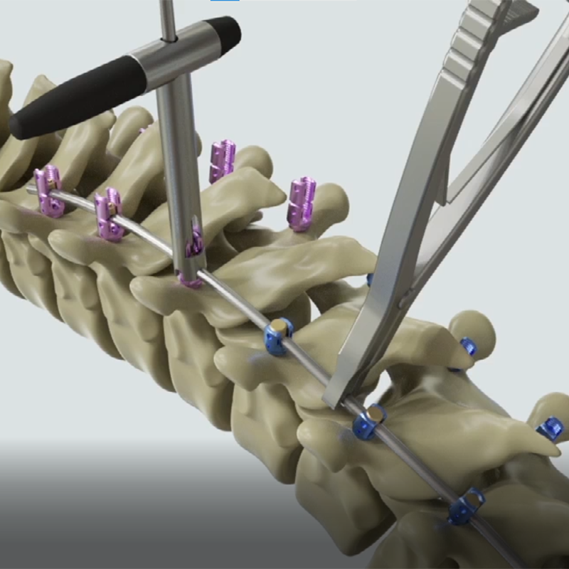 Usmart 5.5mm Titanium Spinal Screw System Most Competitive Price Made for Hospitals in China
