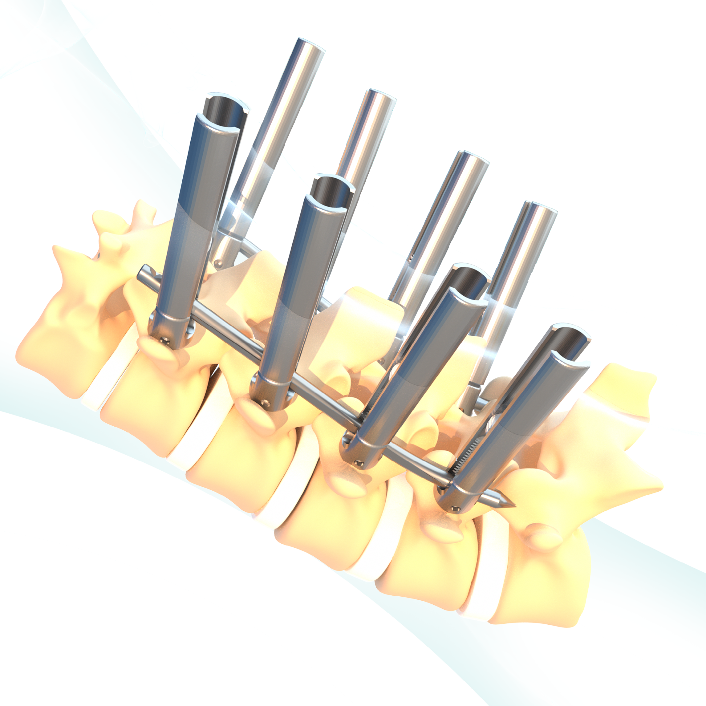 Titanium Artificial Renovation Implant MIS Minimally Invasive Surgery Screws Instruments Orthopedic Surgical Implants Class III