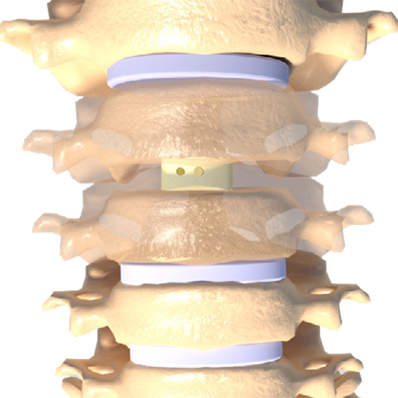 High Quality Round Seamless Neck Minimally Invasive Surgical Medical Product Peek Anterior Neck Cage