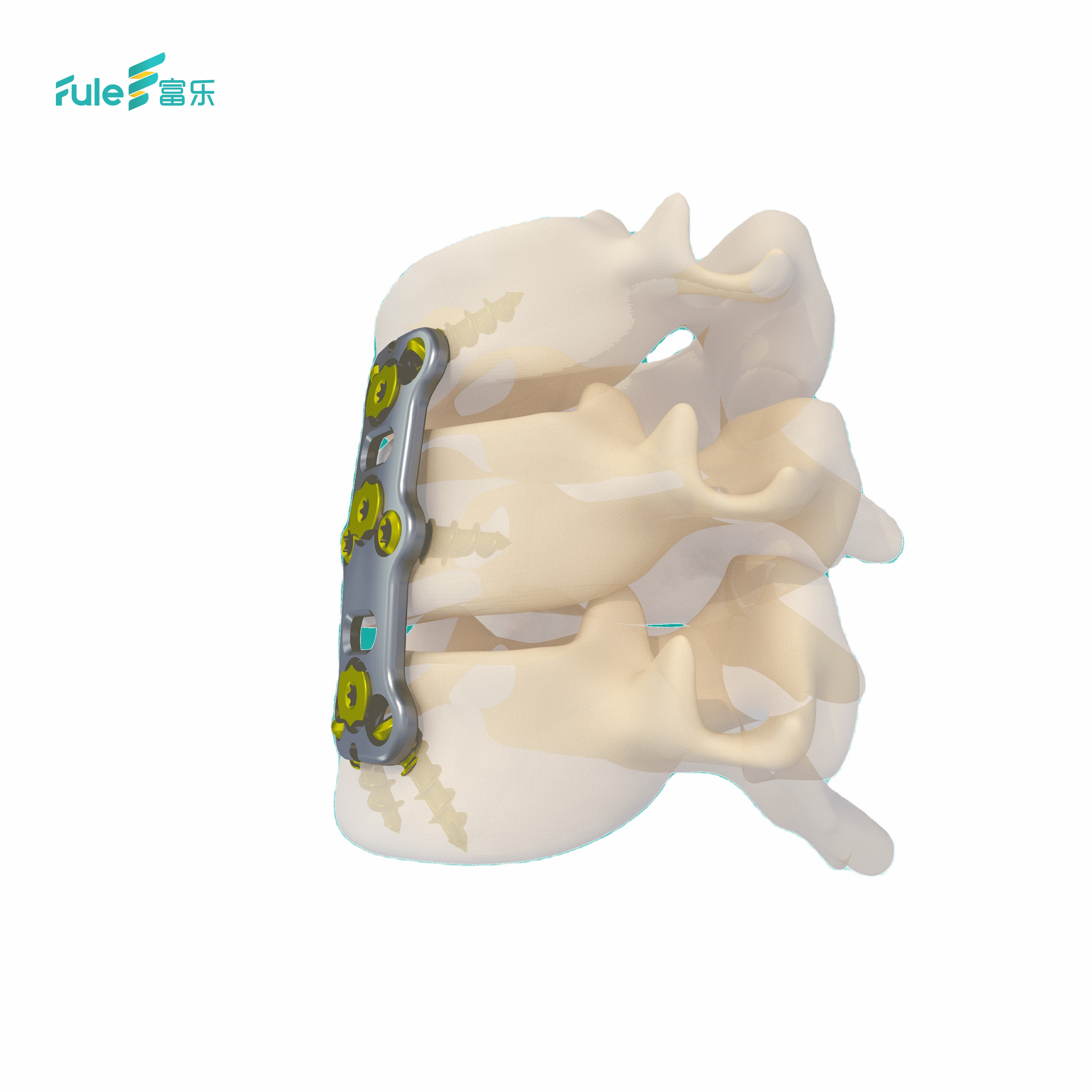 Made in China High Quality Titanium Anterior Cervical Spine Plate System with 5+ Year Warranty