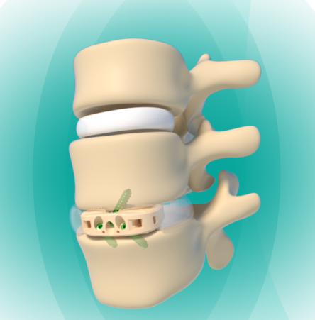 FULE Posterior Lumbar Interbody Fusion Cage Spine Orthopedic Implants ALIF PEEK Class III CE Certified 5-Year Warranty