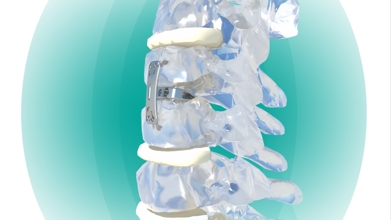 Cervical Interbody Fusion Cage Titanium Wedge-shaped & Arc-shaped for Spine Surgery