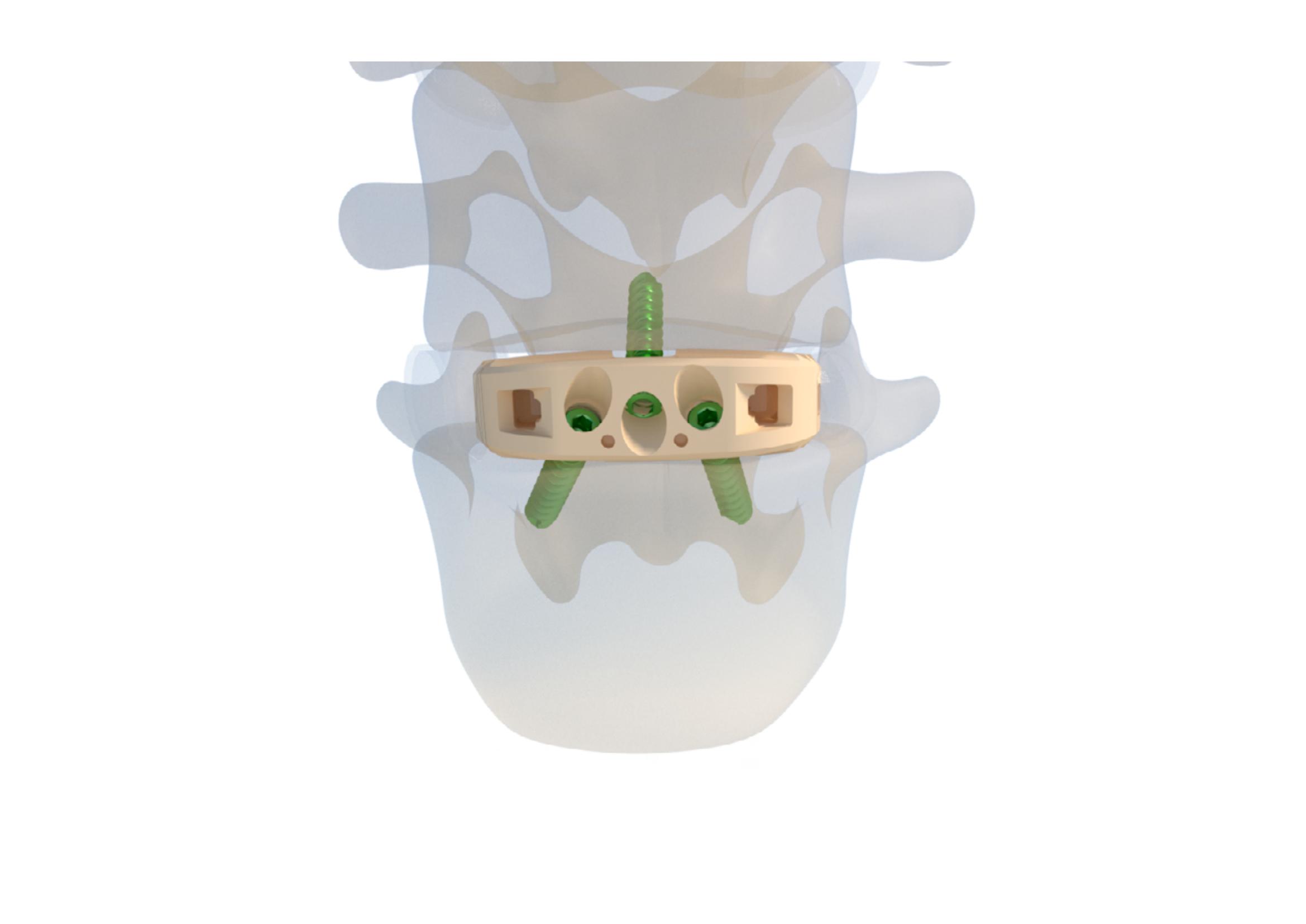 FULE Posterior Lumbar Interbody Fusion Cage Spine Orthopedic Implants ALIF PEEK Class III CE Certified 5-Year Warranty