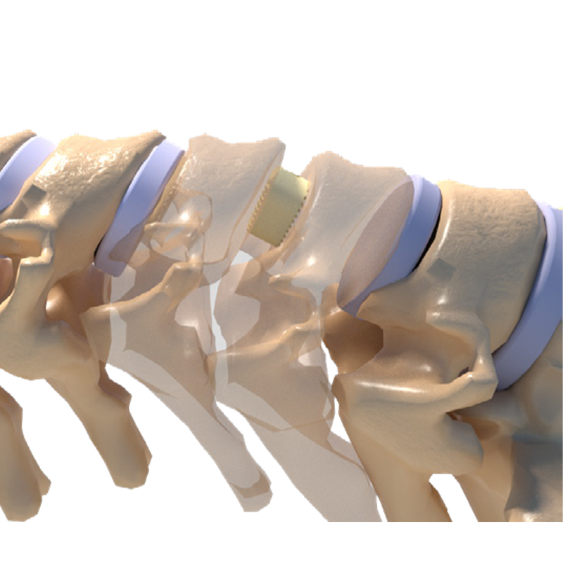 Premium Anterior Cervical Cage Implant Minimally Invasive Medical Product From China Surgical Intervention Titanium Material