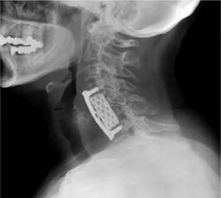 Orthopedic Implant Titanium Mesh Anterior Plates Cylindrical Interbody Fusion Cage Prismatic Hole Fule Brand CE Certified Class