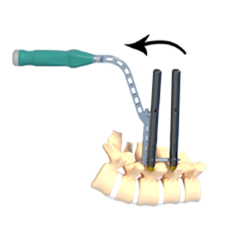 High Quality Fule Brand CE Certified Titanium Medical MikoII5.5 Class III Minimal Invasive Spine Surgery Implant 5+ Year