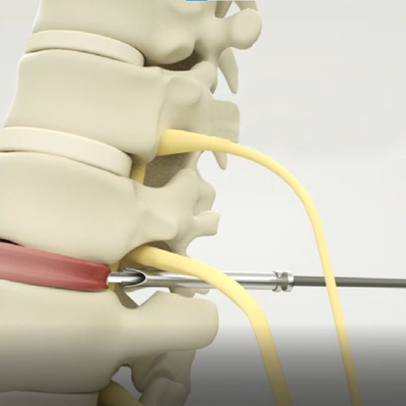 Titanium Alloy Anterior Cervical Intervertebral Fusion Cage for Minimally Invasive Surgery Implantable Artificial Organ