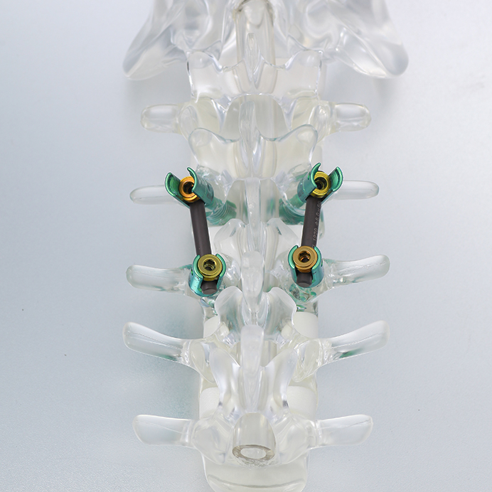 Beijing Fule FXY-A Orthopedic Surgery Implants Anterior Thoracolumbar Plate System