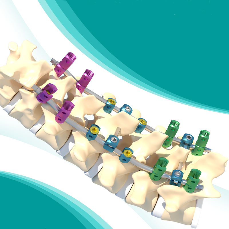 Usmart 5.5mm Titanium Spinal Screw System Most Competitive Price Made for Hospitals in China