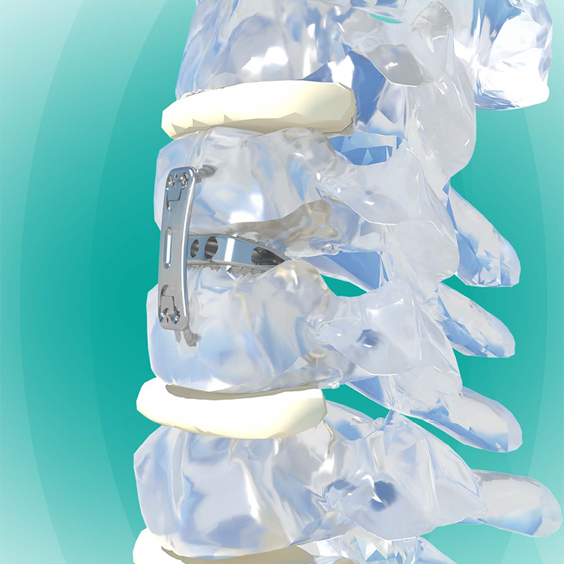 Orthopedic Surgery Implant High Quality Anterior Cervical Interbody Fusion Device Titanium Alloy CE Certified Class III 5-Year