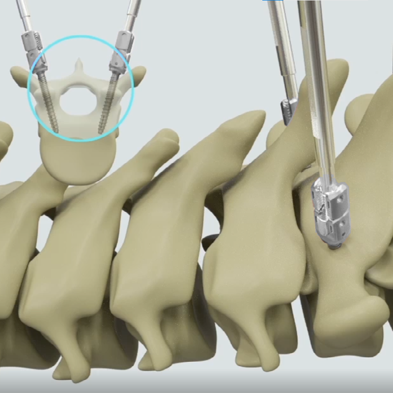 High Quality Titanium Implantable Artificial Organs COX II for Spine Surgery Class III Medical Device