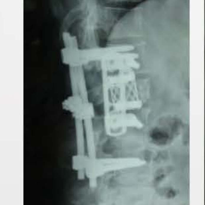 Fule Orthopedic Implant Cylindrical Interbody Fusion Cage Prismatic Hole Titanium Class III CE Certified OEM 5 Years Warranty