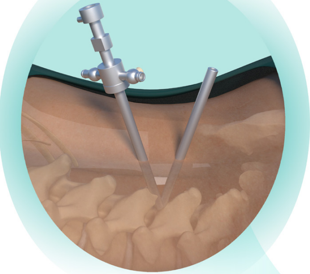 FULE Class III Unilateral Biportal Endoscopy (UBE) Spinal Endoscopic Technique with Over 5 Years Warranty