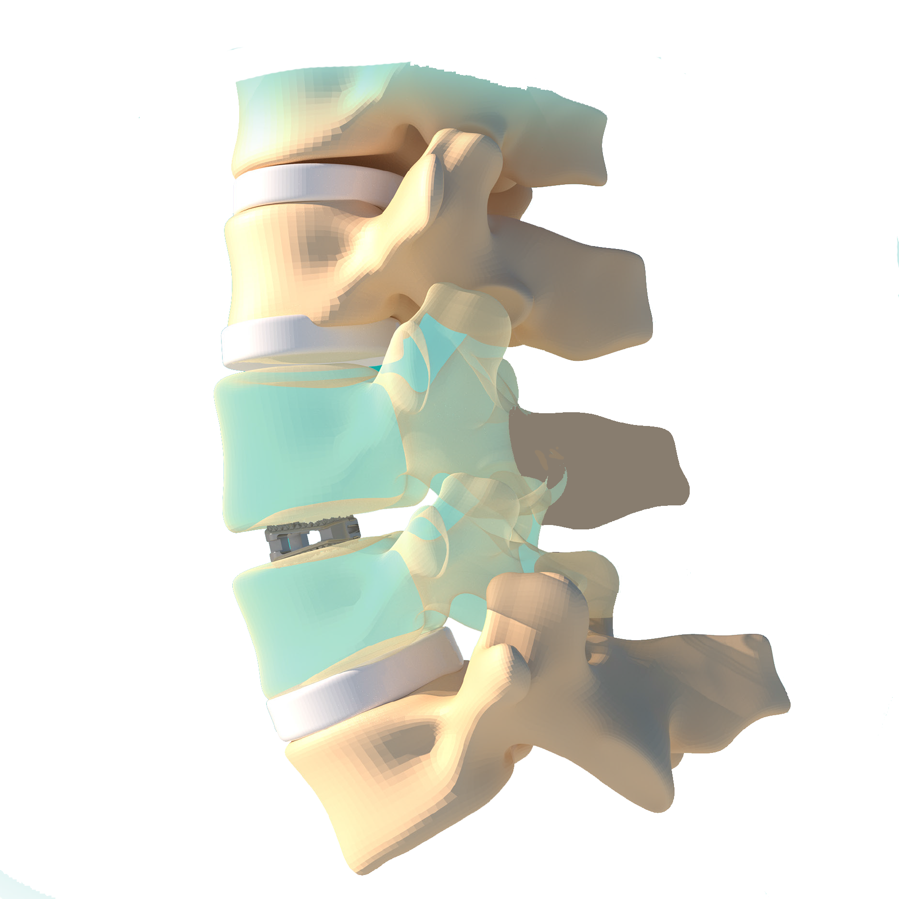 Fule Spine Alif Cage Orthopedic Instrument Set Anterior Lumbar Interbody Fusion Titanium Alloy CE Certified Class III DHL Fedex