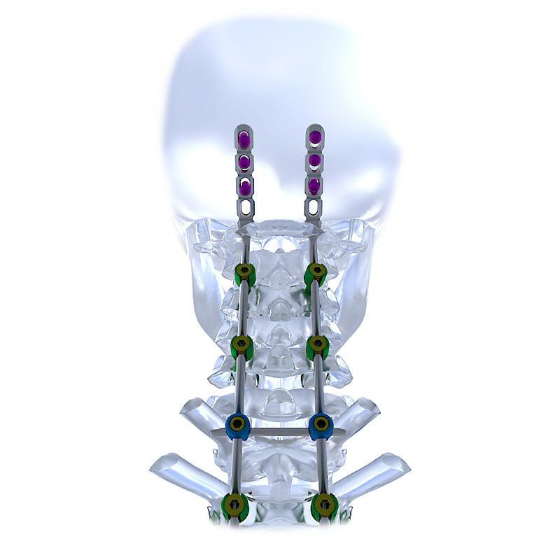 Factory Direct Sales Titanium Anterior Cervical Bone Plate System for Spine Surgery