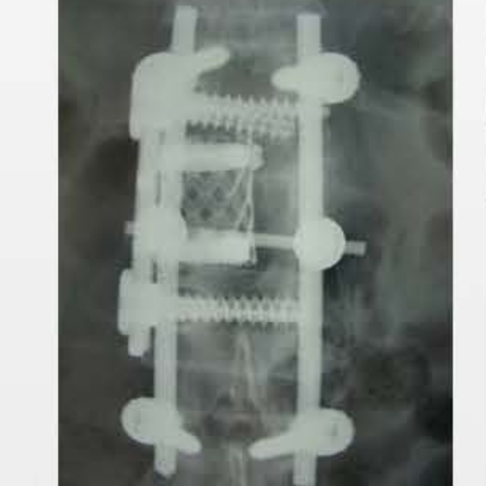 Fule Orthopedic Implant Cylindrical Interbody Fusion Cage Prismatic Hole Titanium Class III CE Certified OEM 5 Years Warranty