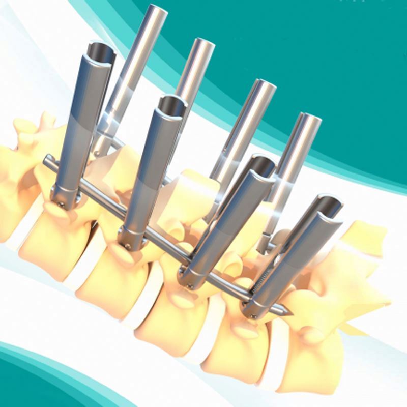 Direct Sales of Titanium Orthopedic Medical Implants and Interventional Materials for Spine Surgery From Manufacturers